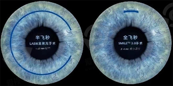 近视手术的种类有哪些