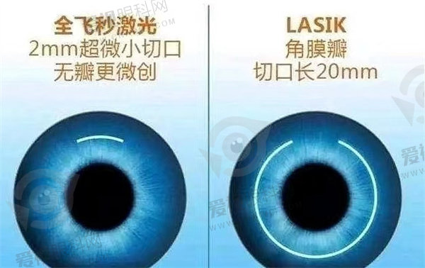 全飞秒激光手术多少钱