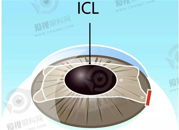 ICL晶体植入价格
