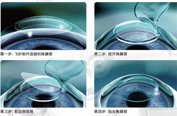 近视手术方式