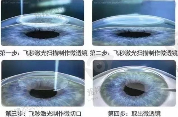 多大可以做近视手术