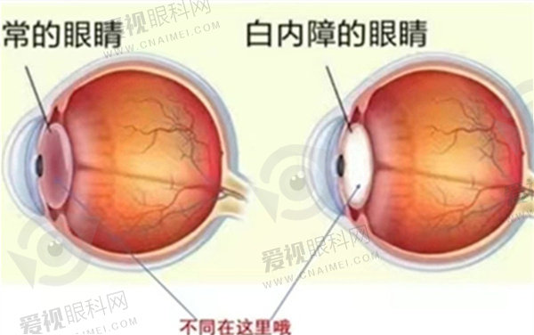 近视手术的几种类型