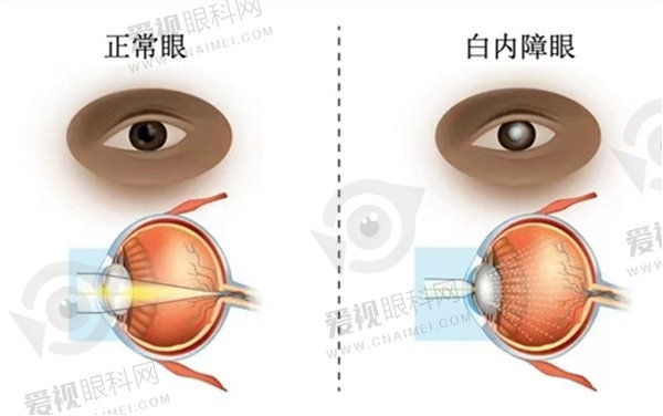 近视手术时间需要多久
