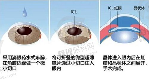 西京医院近视手术怎么样