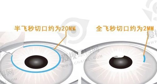 何氏眼科医院做近视手术怎么样