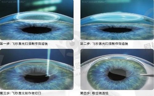 浙大二院眼科医院近视手术怎么样