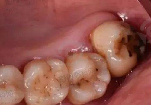 溧阳牙齿矫正费用