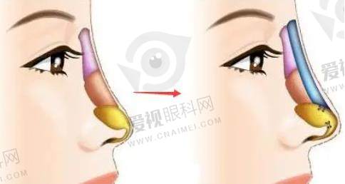 重庆做鼻梁手术大约要多少钱？含重庆鼻整形价格，段艳军做鼻2万起元起