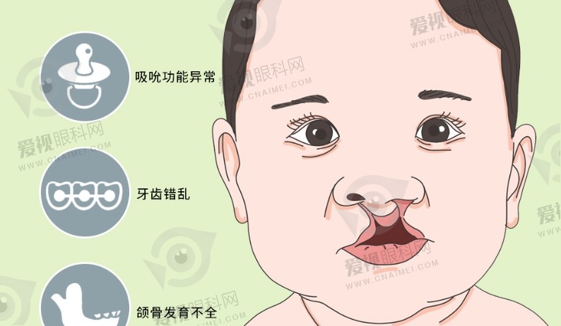 深圳、北京兔唇修复手术要多少钱？北京唇腭裂修复5万元起，广州4万元起，深圳3万元起