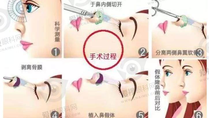 上海鼻子歪了修复手术一般多少钱？2025新价目表显示18800元起，附鼻修复口碑医生徐永丰价格明细